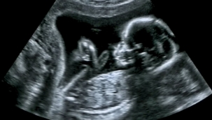 İnsan nesli tehlikede! "2045 yılında sperm sayısı "0" olacak" 